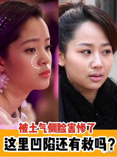 土气脸咋整?鼻基底凹陷有救吗? 羊附上超简单自测方法!