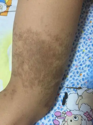 我孩子12岁腿上长出了色斑怎么去除.