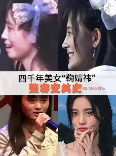 整容前) 很多人看到鞠婧祎的对比照,都觉得她一定削了骨,但其实我们