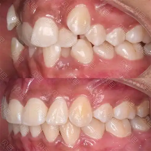 你们谁知道有虎牙的怎么矫正,不能拔!拔了会让嘴巴塌陷