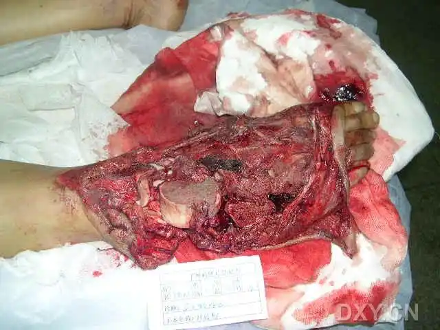 足部严重碾压伤