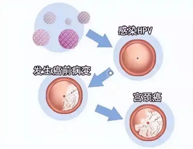 感染了hpv一定会得宫颈癌吗?