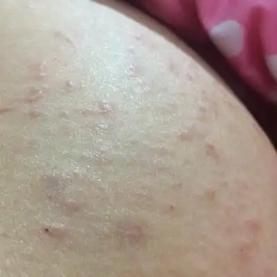 问答 怀孕期 推荐回答                      应该是妊娠痒疹,我前几