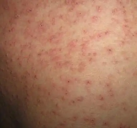 疥疮有什么损害_疥疮_大成皮肤网