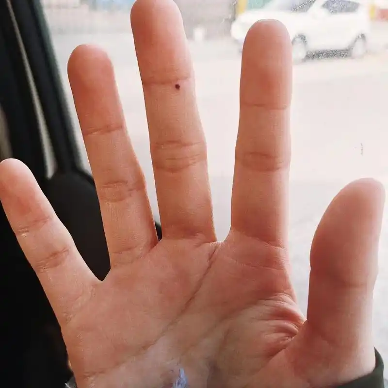 大概是高二的时候,右手中指突然长了个痣.那时候觉得很奇怪,怎 - 抖音