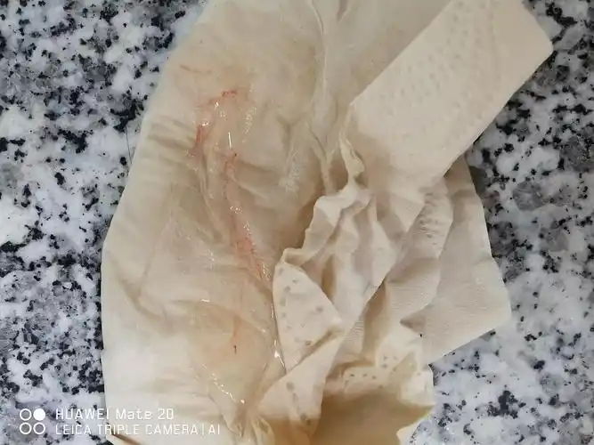 白带有血丝,是什么病阿