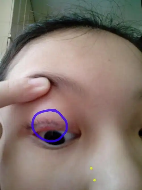 上眼皮长了个小胧包,小小的白色颗粒,有点轻微肿痛(附有图片), 请专家