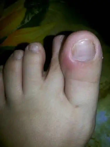 大家对脚气也不陌生了,脚气在夏天的时候是非常常见的一种真菌感染