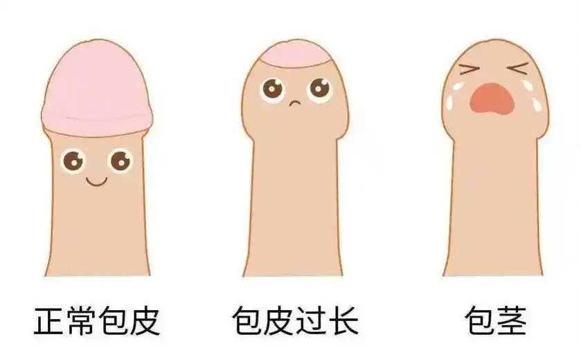 儿童包皮过长一定需要手术吗 - 健康科普 - 柳州曙光医院「咨询挂号」