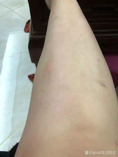 有没有同款,一到夏天小腿两侧就特别痒,越抓越痒,就算破皮还是好痒的