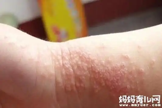 婴儿湿疹初期症状图片别再和痱子傻傻分不清了