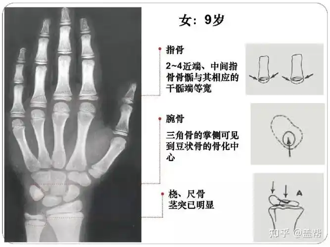 骨龄几岁还能长高吗女孩篇