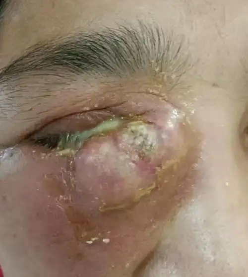 她的右眼红肿明显,眼睛被挤压得只剩下一条缝,眼内有大量脓性分泌物