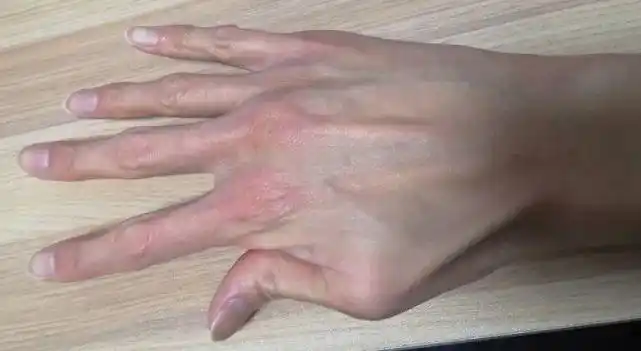 在年轻的主动脉夹层患者中,很多都是马凡氏综合征患者.