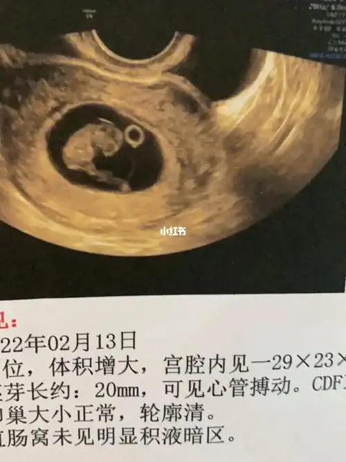 八周三天的胎心胎芽