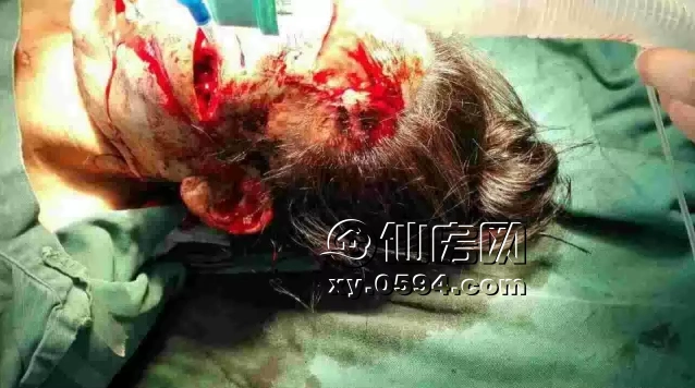 仙游园庄镇女子面部遭人狂砍十多刀,惨不忍睹!