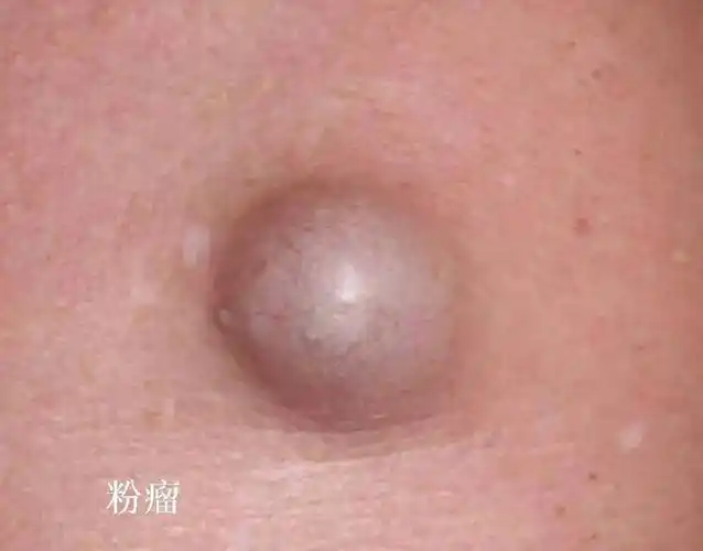 粉瘤皮脂腺囊肿