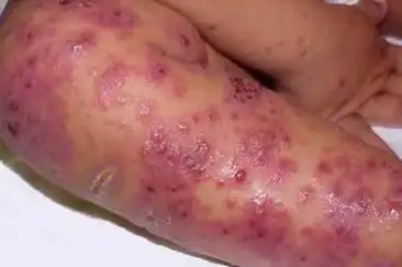 腿部湿疹症状有哪些_湿疹_苏州乐桥皮肤专科,苏州医保定点皮肤病专科