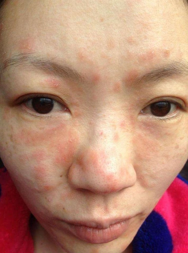 过敏皮炎症状图片61