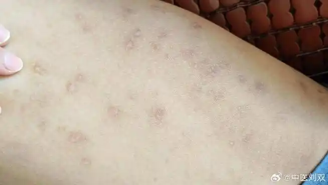 中医##湿疹#男,14岁,下肢皮肤干燥瘙痒,伴皮损1周,大的如铜钱,破舜Ζ