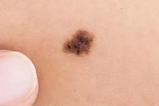 正常痣和黑色素瘤图片