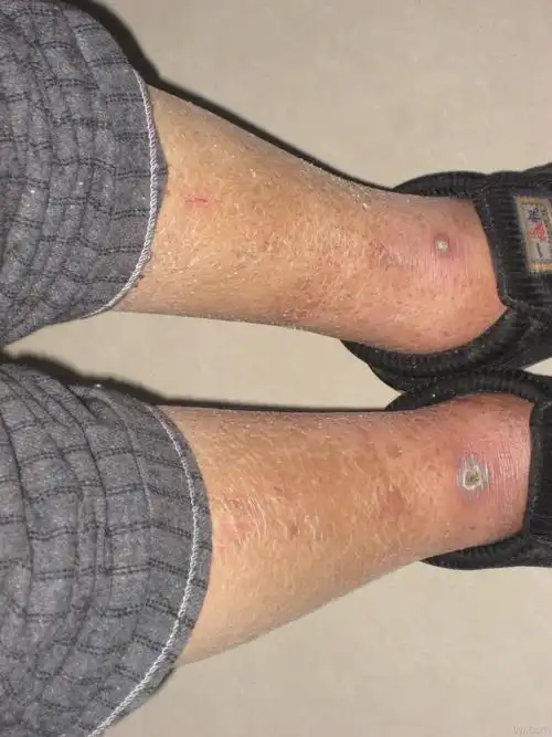 血糖升高15年双下肢水肿20天就诊治疗中