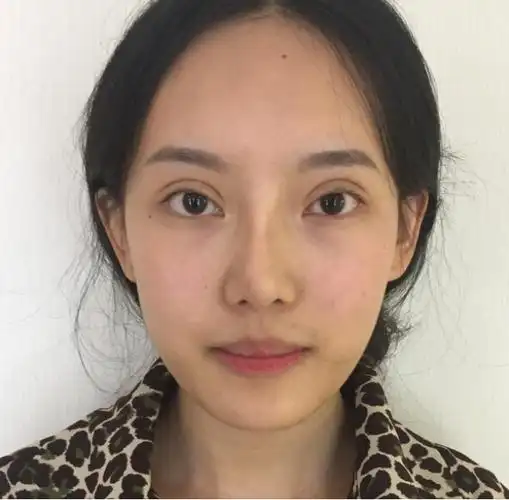 双眼皮过宽修复难吗求名单杭州专业医院