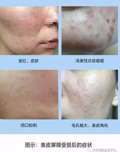 什么是受损的皮肤屏障?