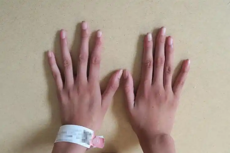 过去有统计数据显示,1/3的马凡氏综合征患者死于32岁前,患者平均年龄