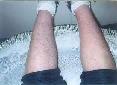 得了过敏性紫癜吃什么好_紫癜预防_南昌中山皮肤病医院