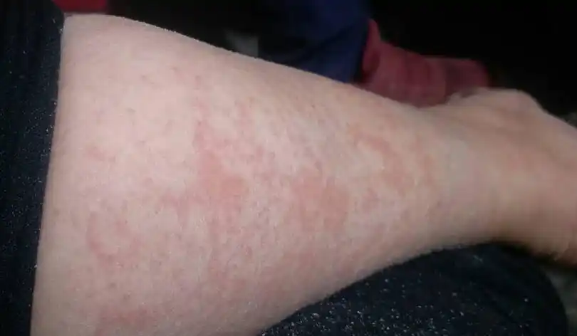 孕中期全身痒,身上都是这样的,谁知道是什么原因?