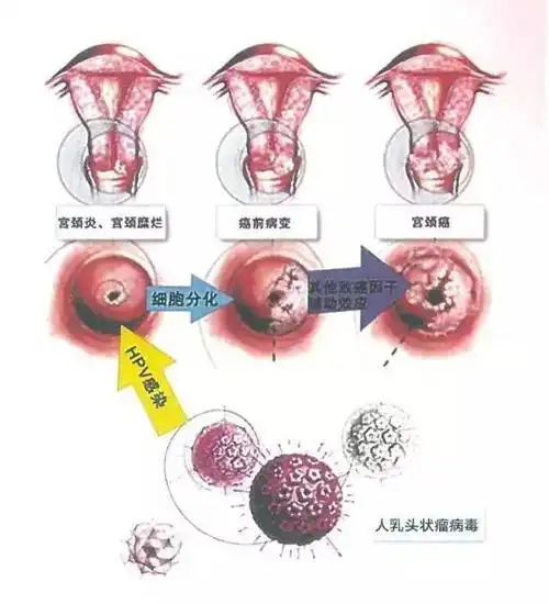 女性健康,从宫颈癌筛查开始