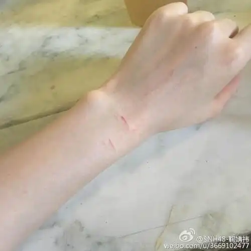 鞠婧祎手臂多处伤痕:舞蹈与服装碰擦出的爱的火花