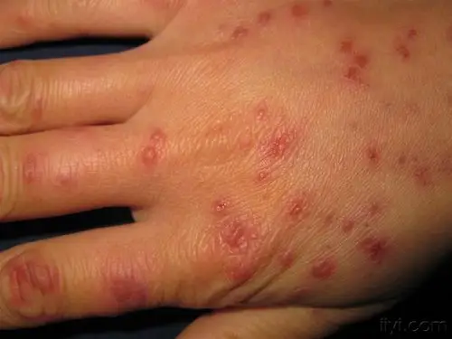 看图识病-------多形红斑 - 皮肤及性传播疾病讨论版 - 爱爱医医学
