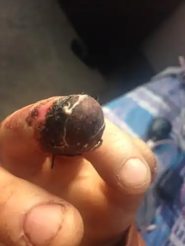 我的手指头被缝针了.目前颜色发黑是不是就坏死了?