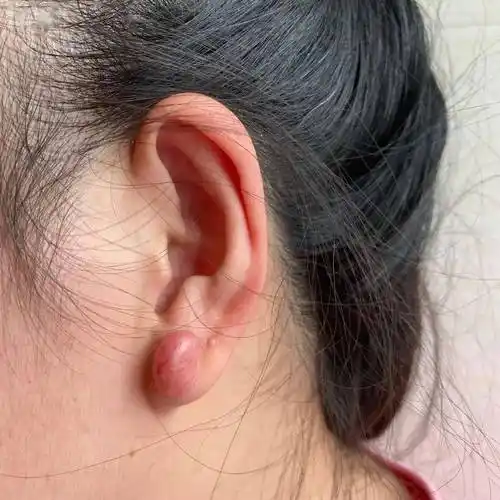 "王女士坦言.最终,在医生的建议下,她通过手术切除了左耳的肉疙瘩