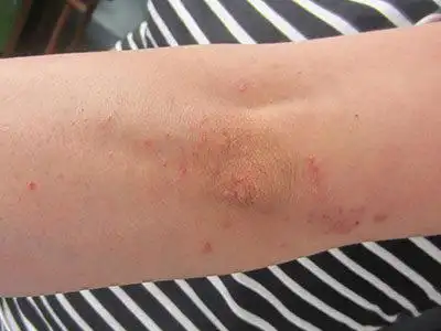 银屑病什么症状图片