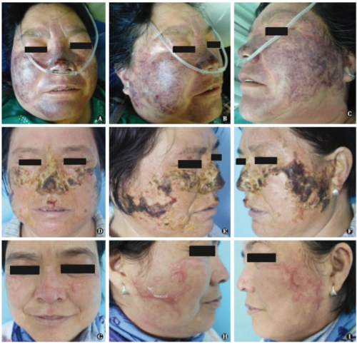 重症植物日光性皮炎1例