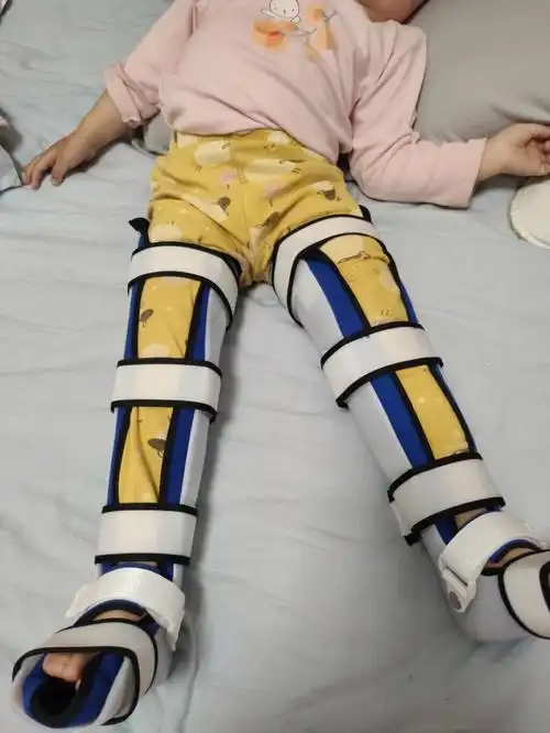 记录x型腿28个月宝宝佩戴支架