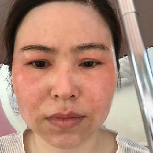 角质层薄脸总是红红的遇热就烫的发紫怎么办