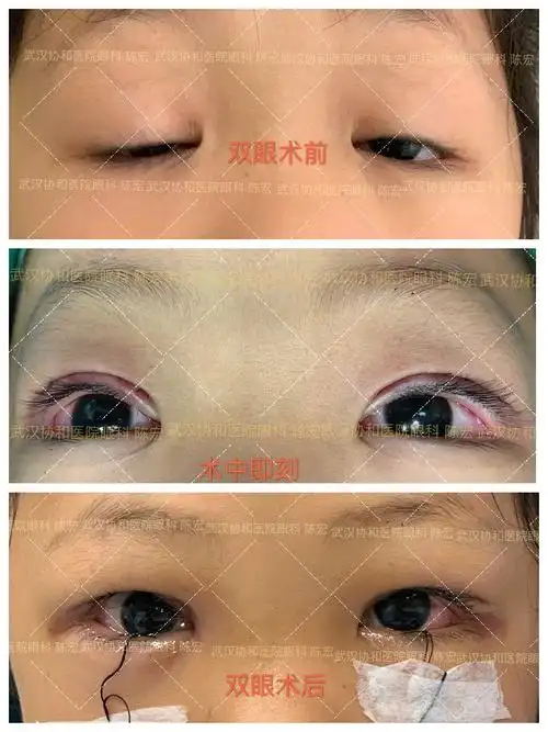 先天性上睑下垂手术及复发性上睑下垂修复手术病例 - 好大夫在线