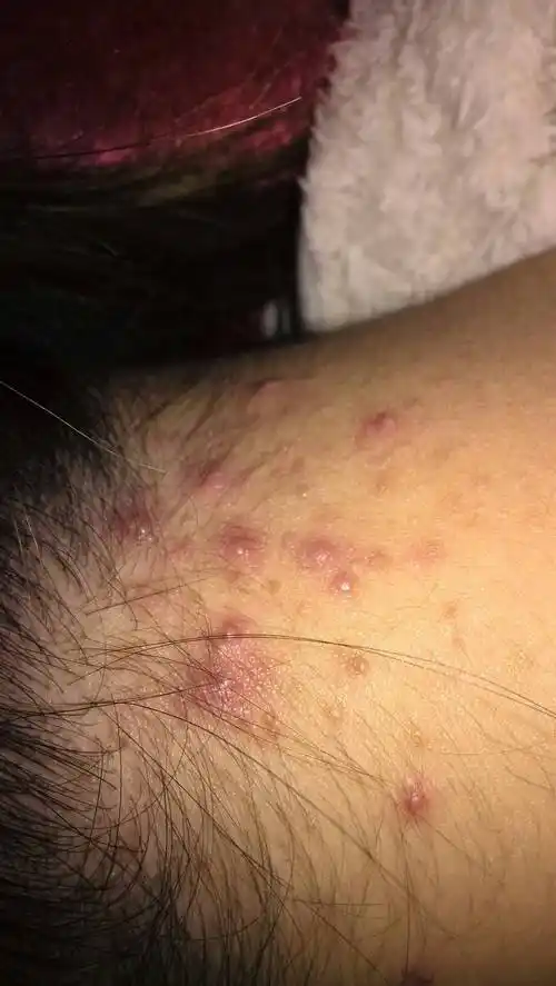 脖子后面长有一些脓包,有点痒,背上有点好了,请问这是什么病?