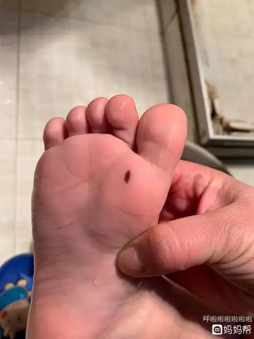 有没有宝宝脚底长黑痣的情况