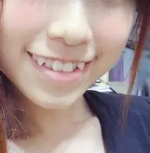 儿童虎牙要如何矫正