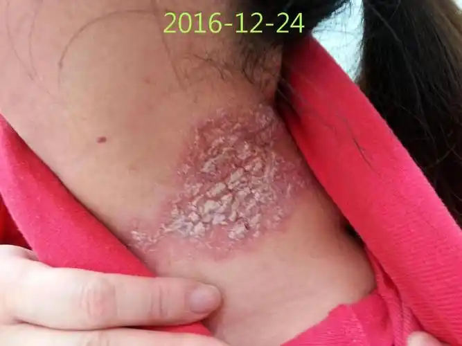 某患者,女,患神经性皮炎多年.  2016年12月,前来就诊.