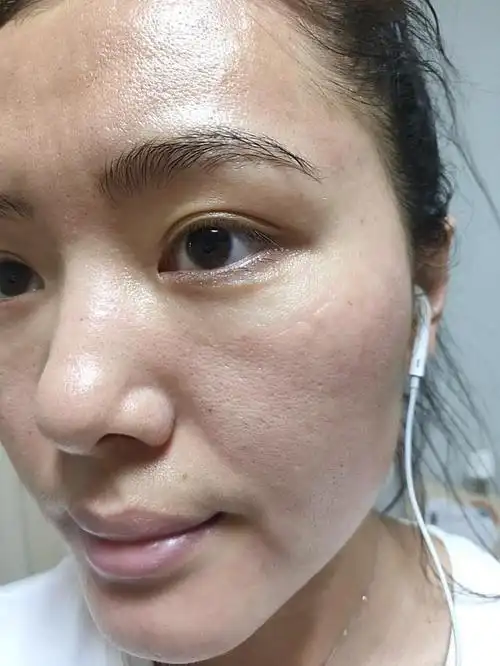 想收缩毛孔,有哪些医美方法可以选择?