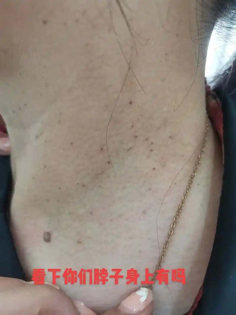 专业的事交给专业的人 丝状疣是怎么引起的:丝状疣主要是由于 - 兑趑