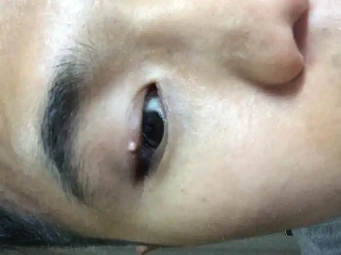 眼睛长了个东西,挺久的了半年左右了吧,最近发现好像大了点