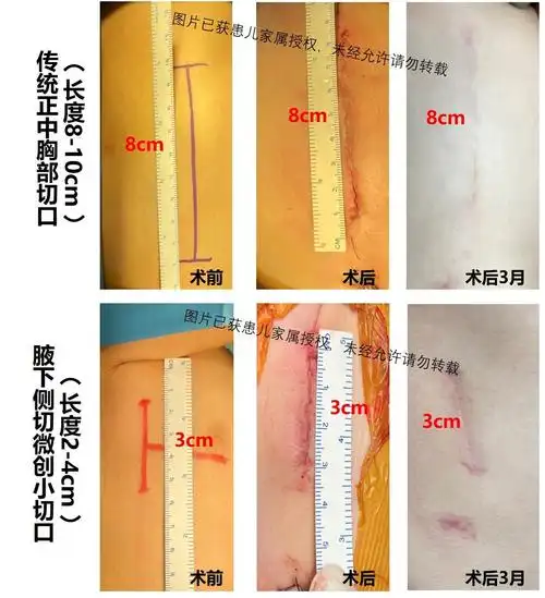 晓敏医生讲先心---先天性心脏病(室间隔缺损,房间隔缺损,动脉导管未闭