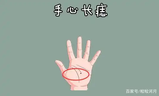 手心长痣
